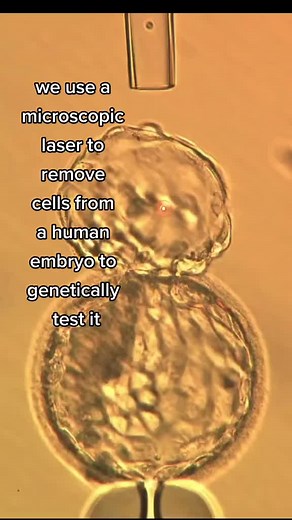 2.6M views · 12K reactions | Biopsy of a living human embryo with a microscopic laser so we can genetically test it to identify those most likely viable . #ivf #embryo #pgt #embryobiopsy #ivfsuccess #laser #goldcoastivf #ttc #infertility #infertilitywarrior #miracleoflife #life #genetictesting #genetics | Steven Palter | Facebook