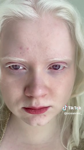 Understanding Nystagmus and Albinism: Why Do Eyes Shake?