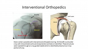 What Is Interventional Orthopedics?