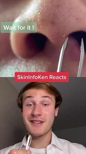 Tweezing Dead Skin Cells and Oil Plug Removal