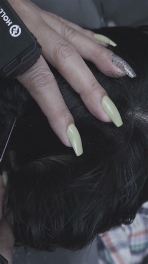 Combing Out Dandruff Flakes and Picking Scratching Dandruff Scalp