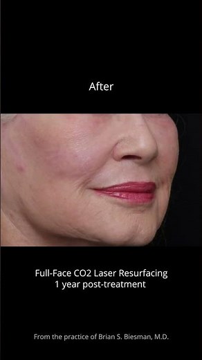 CO2 Laser Resurfacing Before and After