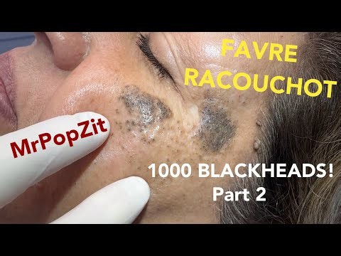 Here it is! 1,000 blackheads part 2.Unbelievable amount of keratin extracted from the cheeks! Favre!