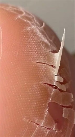 “Deep Heel Callus Peel | Extreme Dead Skin Removal 4K” #satisfying