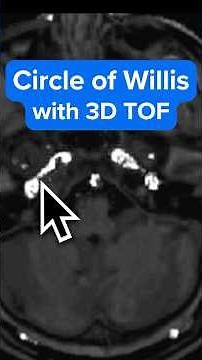 MRI Circle of Willis Imaging with 3D TOF Sequence