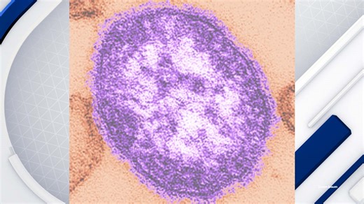 Coconino County resident tests positive for measles