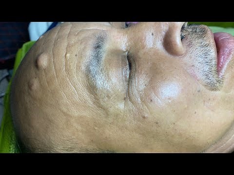 Acne treatment for Spa Linh Mun 2023 #012