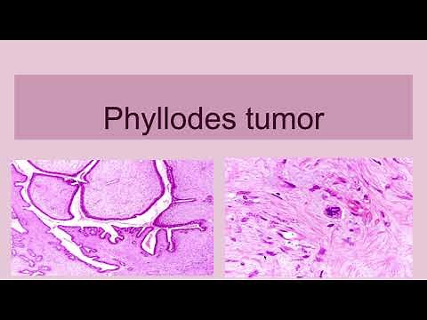Phyllodes Tumor of Breast
