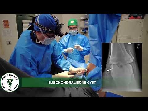 DCLAH Services - Subchondral Bone Cyst Surgery