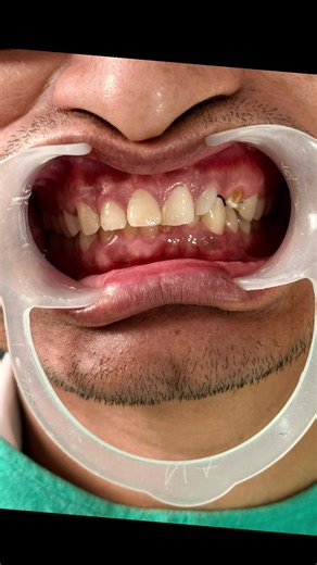 From missing teeth to a flawless smile — zirconia bridge magic 🦷✨ #mirrordentalclinicpokhara #dentalinpokhara #zirconiabridge #crownandbridge #dentalimplantsinpokhara