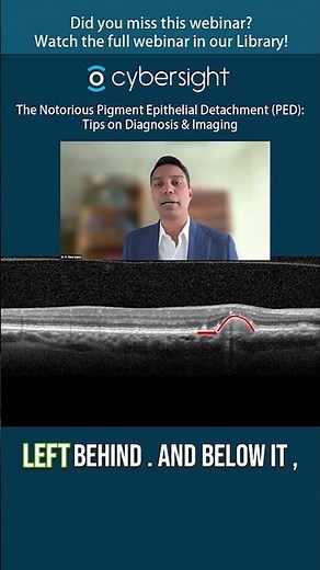 Lecture: The Notorious Pigment Epithelial Detachment (PED): Tips on Diagnosis & Imaging