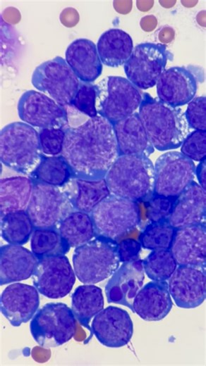 Mustafa Elsobky on Instagram: "Geriatric Himalayan / 14 yo Intact Female / FNA From Submandibular LN / Lymphoma 💫🔬 Sample : FNA from Submandibular Lymph Node 💉 Aspirate appearance: Moderate cellular yield with minimal to mild blood contamination. Test : FNA Cytology 💫🔬 Cytology Report : Highly cellular dominated by a monomorphic population of large lymphoid cells (lymphoblasts). Cells exhibit high nuclear-to-cytoplasmic ratio, round to oval nuclei with coarse chromatin and prominent nucleol