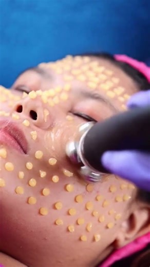 Penetration and massag with rf tool#amazing results #beautful skincare #viral shorts 😍