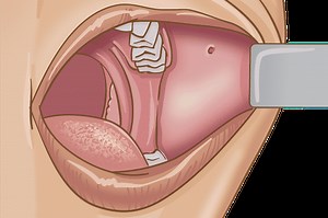 Buccal Cancer ‣ Oral Cancers ‣ THANC Guide