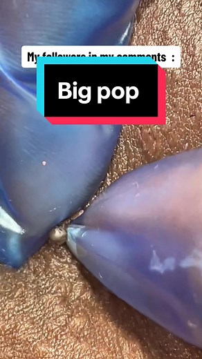 Galaxy Extractions and Ingrown Hair Removal | Passionate Extraction Session