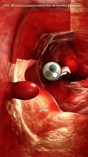 Colonoscopy Procedure!!(3D Animation) #colonoscopy #colonoscopyprep #colonoscopyday