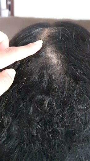 Elimina los piojos y liendres de tu cuero cabello, en 30 segundos. | Mi receta Genius