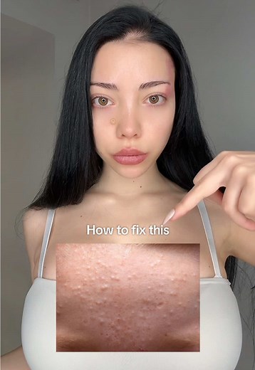 Effective Way to Treat Closed Comedones (Whiteheads)