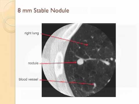 GRACEcast-087_Lung-Cancer_Detection and Work-Up of Lung Nodules, by David Yankelevitz