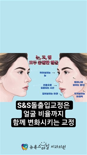 S&S돌출입교정은 얼굴 비율까지 함께 변화시키는 교정