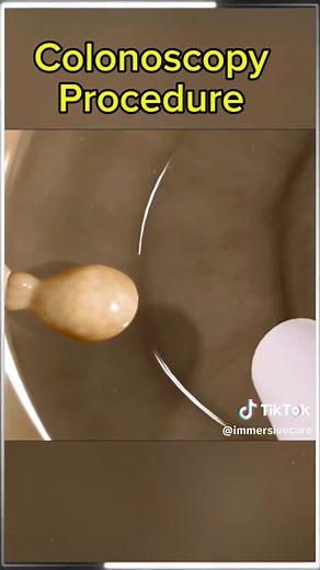 How Colonoscopy is performed? #colonoscopy #colonoscopyday #colonoscopyday #colonoscopyprepcheck #colonoscopycheck #coloncancer #colonpolyp #polypectomy #medical3danimation #3dmedicalanimation