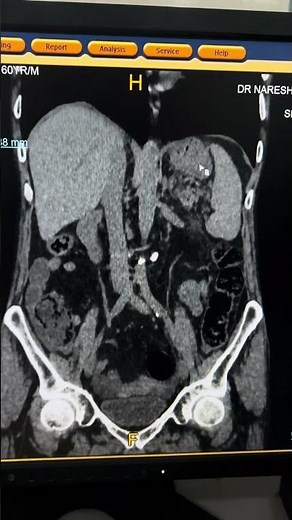 Acute Pancreatitis on CT: Key Insights and Diagnostic Tips