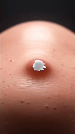 pimplepopping |acne removal 2.0 #acneremoval #satisfying #dermatology #acneextraction #blackhead