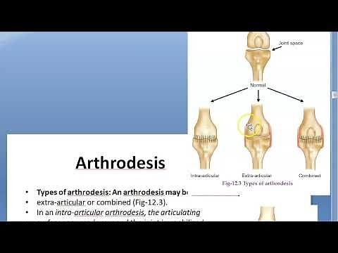Orthopedics 102 Arthrodesis fusion of joint Triple arthrodesis for Polio CTEV GCT Osteoclastoma