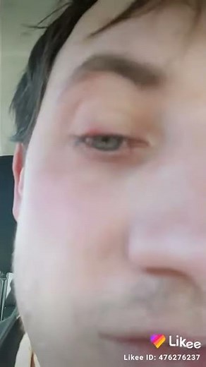Bouton sous la paupière, Orgelet ou Chalazion, avant de voir le médecin généraliste.