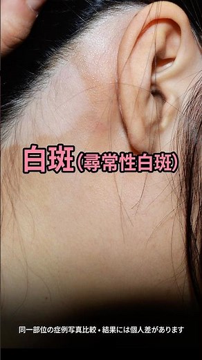 【白斑回復】白く抜けた肌が元通りになるまで 🇰🇷