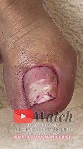 4.6K views · 20 reactions | “Toenail Repair & Fungus Removal |...