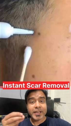 Pimple Marks Removing Cream👆 #treatment #bestproducts #bestproducts