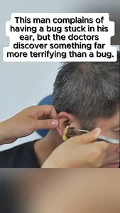 30K views · 1.7K reactions | He went to the doctor thinking a bug was in his ear… but what they pulled out was way more terrifying  Watch until the end — you won’t believe it!  #Unbelievable #MedicalMystery #ShockingDiscovery | Chillstrillstv | Facebook