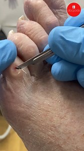 1.3K views | A corn on the 5th toe, often referred to as the "pinky...