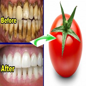 We hypothesized, the contains of hydrogen peroxide (H2O2) in tomato (Lycopersicon esculentum Mill) can be an alternative whitening material. Methods: The experimental research was using 10 post-dental extraction teeth as samples. The teeth smeared with tomato juice and incubated for 2 hours at a temperature of 37°C. | Health Zone