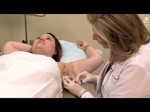 Botox for Underarm Sweating (Hyperhidrosis) - by Dr. Lori Stetler