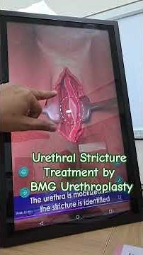 How BMG Urethroplasty is done for Urethral Stricture.