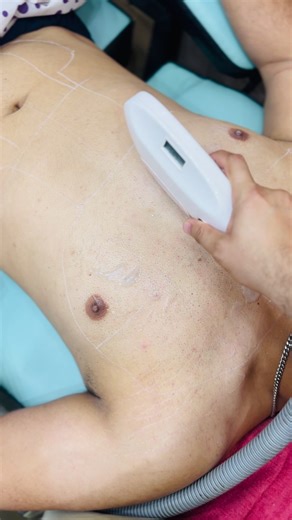 chest laser hair removal #frypgシ #foryou #vairalvedio #lzskininic