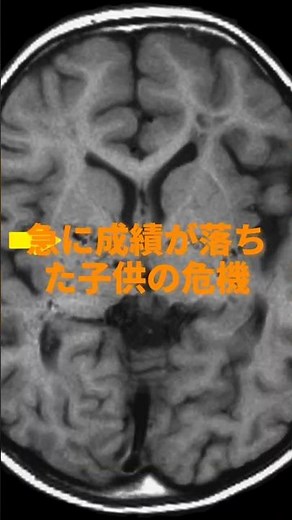 子供の成績低下の裏に潜む病気【もやもや病】