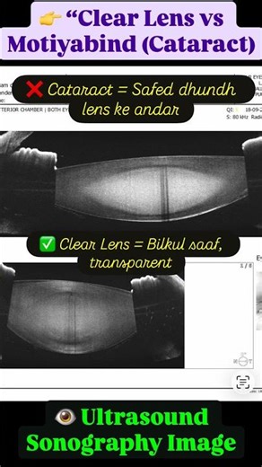 👁️ Motiyabind (Cataract) on Sonography vs Clear Lens | Eye Awareness |