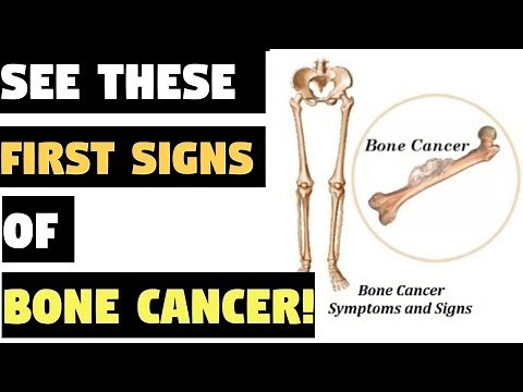 If You See These First Signs, You Are Developing Bone Cancer!