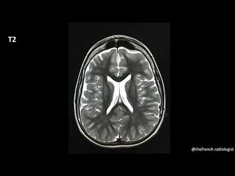 TFR : les séquences IRM