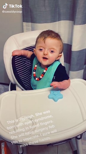 Understanding Apert Syndrome and Brain Surgery in Kids