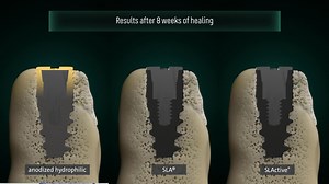 107 reactions |  Not all hydrophilic implants are the same. Explore the brand new pre-clinical data that has recently been published* by tapping the link in our bio. *Shahdad S. et al. Osseointegration of Anodized vs. Sandblasted Implant Surfaces in a Guided Bone Regeneration Acute Dehiscence-Type Defect: An In Vivo Experimental Mandibular Minipig Model. Clin Oral Implants Res. 2024 Oct 10 | Straumann | Facebook