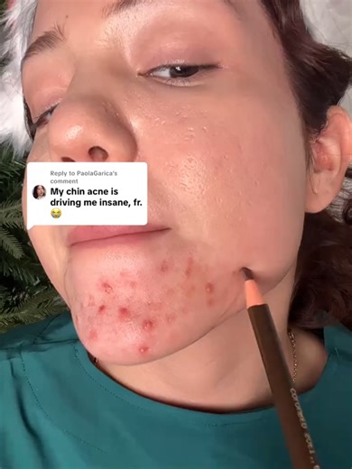 Effective Acne Control and Unclogging Pores