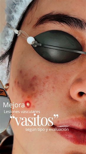 Láser ZYE de picosegundos: tratamiento para manchas y melasma