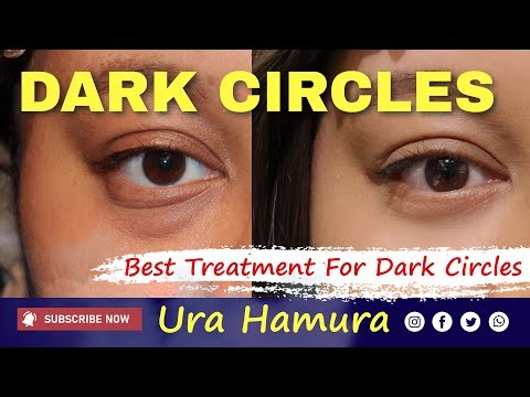 Best Surgery for Under Eye Bags and Dark Circles? Ura Hamra: Real Patient Story & Results
