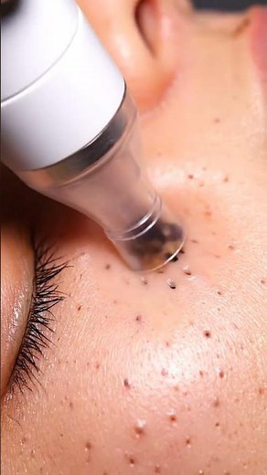 Blackhead Removal Vacuum | Deep Pore Cleaning Close-Up