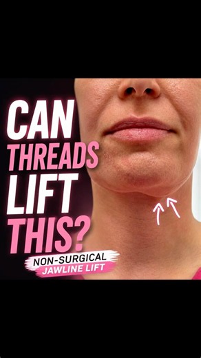 Jowls Gone Without Surgery? 🤯 Silhouette Threads Explained