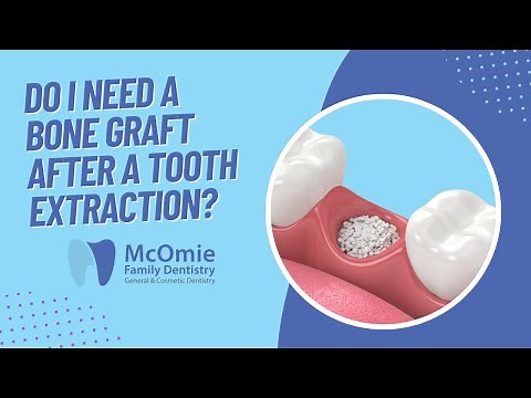 Do I Need A Bone Graft After A Tooth Extraction? Chattanooga Dentist Dr. McOmie Explains